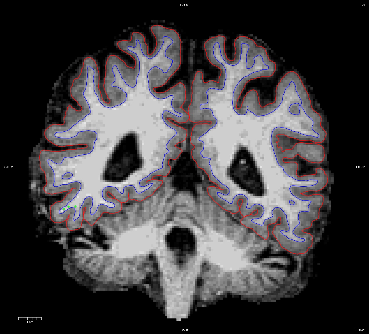 cp_slice_103_long1_after.jpg