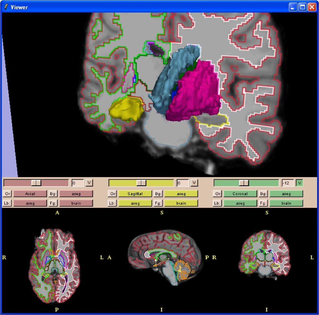 FreesurferSlicer1.jpg