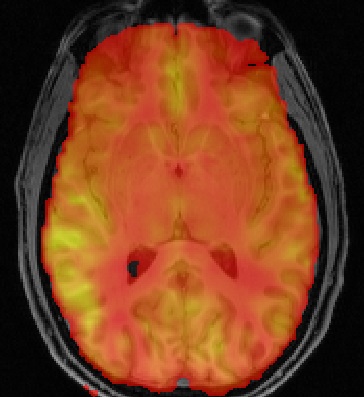 BASIL perfusion